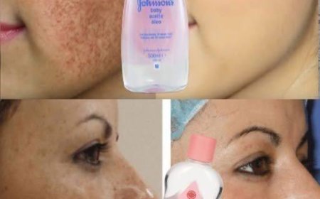 Melasma, Falten, Flecken: Entdecken Sie die Kraft von Johnsons Öl dagegen