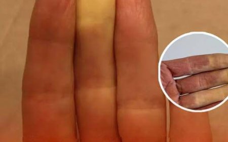 Was es wirklich bedeutet, wenn einer deiner Finger weiß wird, wenn es kalt ist