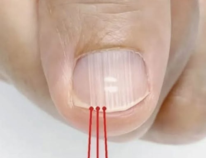 If you have these lines on your nails after 40, it is a clear sign that