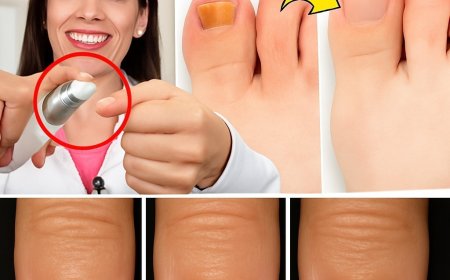 I never had toenail fungus or mycosis again after using this recipe.