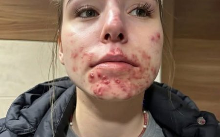 The Hidden Reasons You Keep Getting Pimples on Your Chin