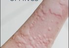 What Are Hives? Symptoms, Causes, Diagnosis, Treatment, and Prevention