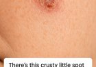 The Crusty Spot That Won’t Heal: What Your Skin May Be Trying to Tell You