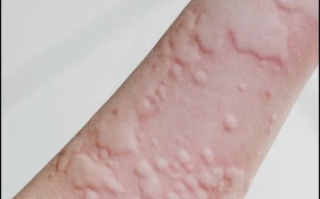What Are Hives? Symptoms, Causes, Diagnosis, Treatment, and Prevention