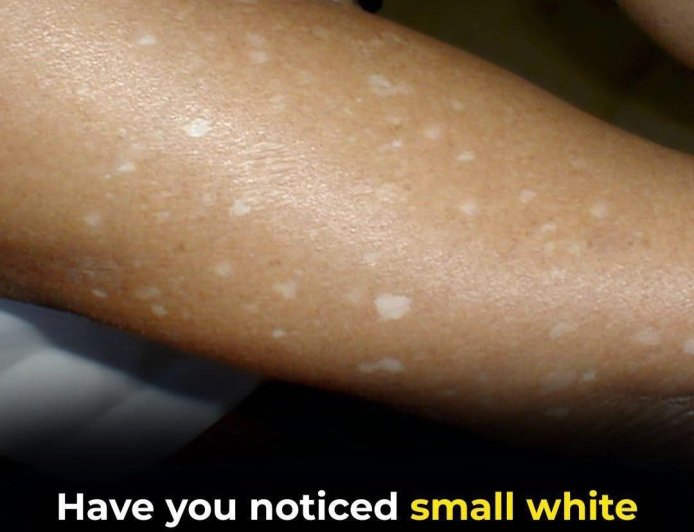 White Spots on Skin: Which Vitamin Deficiencies Could Be the Cause?
