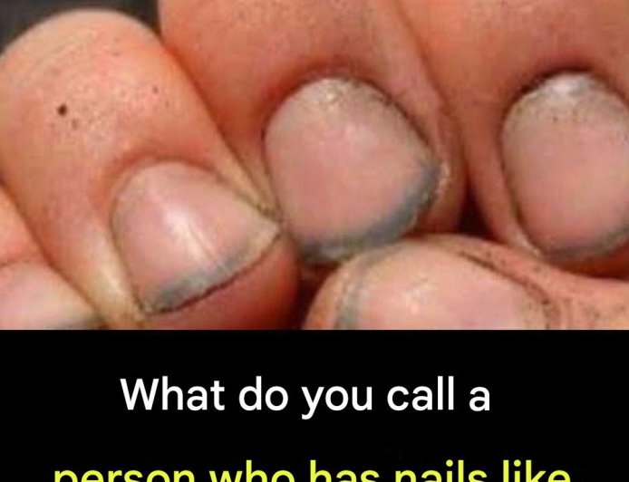 What do you call a person who has nails like that?